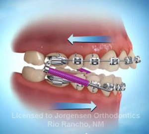 13 - Dispositif fixe d'avancée mandibulaire